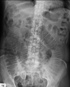 resumo obstrução intestinal