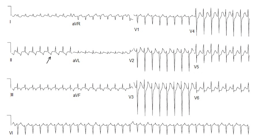 taquicardia supraventricular